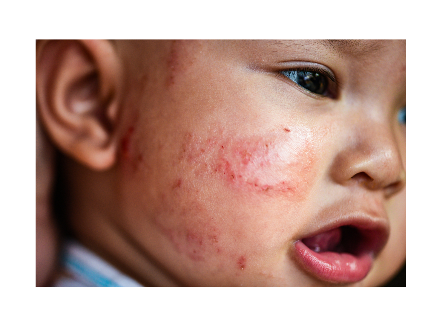 Tips for Managing Eczema in Children