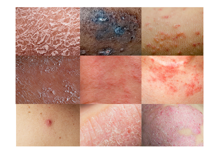 Different Types Of Eczema P2 And You 